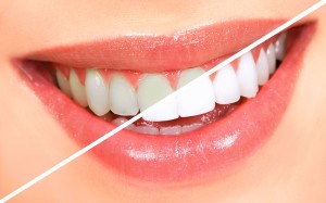 Dental Whitening Procedure